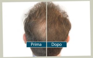 tricopigmentazione con effetto densità per infoltire i capelli