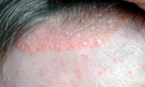 Dermatite seborroica e tricopigmentazione