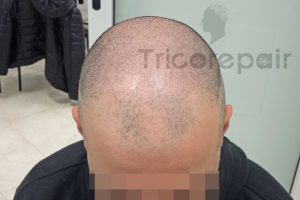 Alopecia androgenetica prima del trattamento