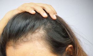 Tricopigmentazione su alopecia femminile: un grande aiuto per combattere l’alopecia nelle donne.