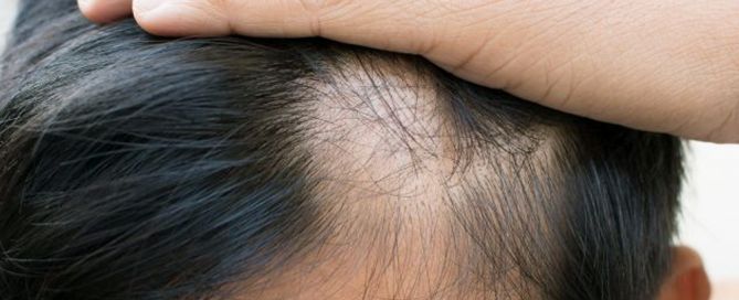 Come intervenire sull’alopecia cicatriziale del Lichen Plano Pilare