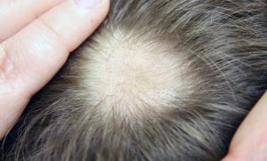 Alopecia areata, di cosa si tratta?
